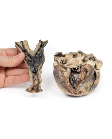 Malattia idatidea che colpisce il cuore e l aorta Erler Zimmer 3D anatomy