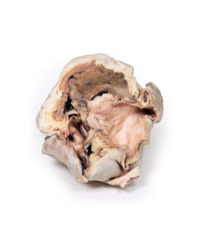 Stenosi valvolare aortica calcificata Valvola aortica bicuspide Erler Zim