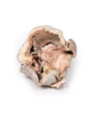 Stenosi valvolare aortica calcificata Valvola aortica bicuspide Erler Zim