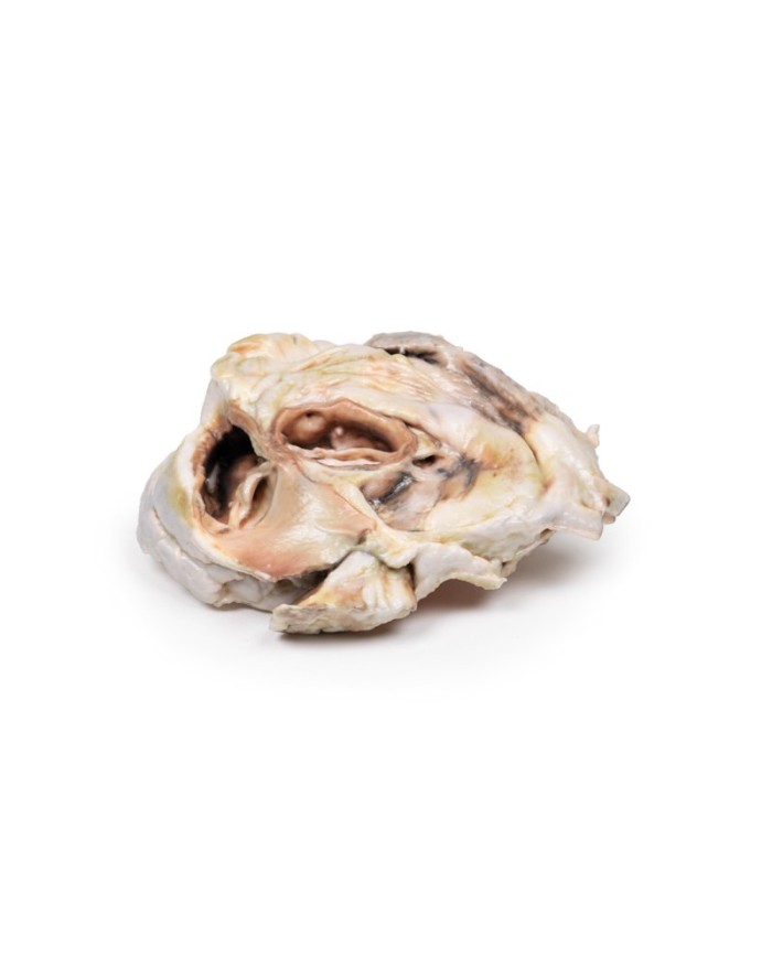 Stenosi valvolare aortica calcificata Valvola aortica bicuspide Erler Zim