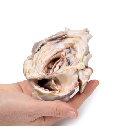 Stenosi valvolare aortica calcificata Valvola aortica bicuspide Erler Zim