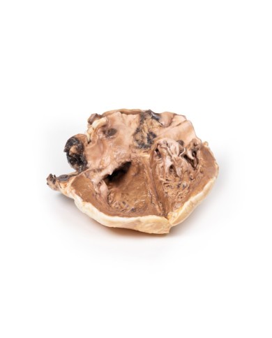 Endocardite reumatica Erler Zimmer 3D anatomy Series MP2039