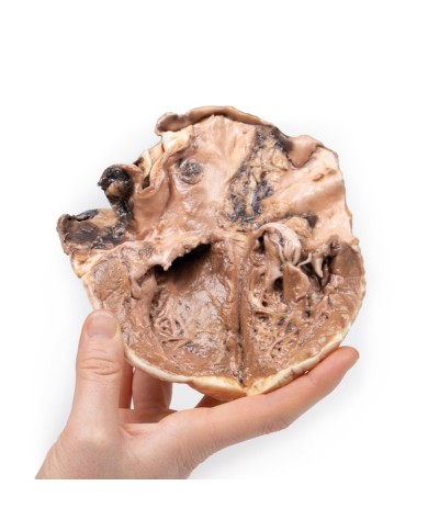 Endocardite reumatica Erler Zimmer 3D anatomy Series MP2039