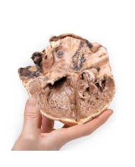 Endocardite reumatica Erler Zimmer 3D anatomy Series MP2039