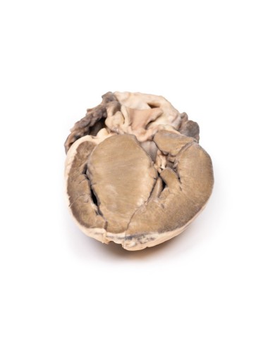 Stenosi subaortica ipertrofica Erler Zimmer 3D anatomy Series MP2036