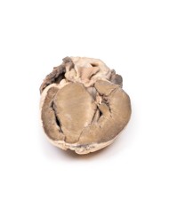 Stenosi subaortica ipertrofica Erler Zimmer 3D anatomy Series MP2036