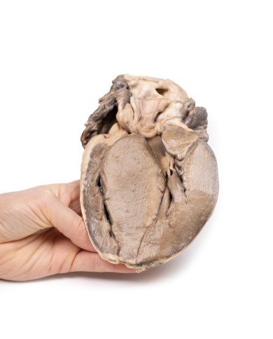 Stenosi subaortica ipertrofica Erler Zimmer 3D anatomy Series MP2036