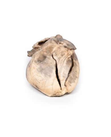 Stenosi subaortica ipertrofica Erler Zimmer 3D anatomy Series MP2036