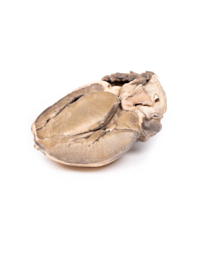 Stenosi subaortica ipertrofica Erler Zimmer 3D anatomy Series MP2036