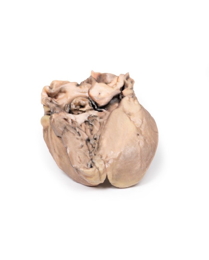 Endocardite batterica acuta Erler Zimmer 3D anatomy Series MP2041