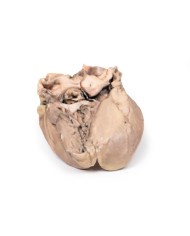 Endocardite batterica acuta Erler Zimmer 3D anatomy Series MP2041