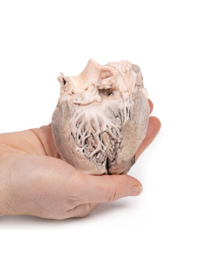 Endocardite batterica acuta Erler Zimmer 3D anatomy Series MP2041