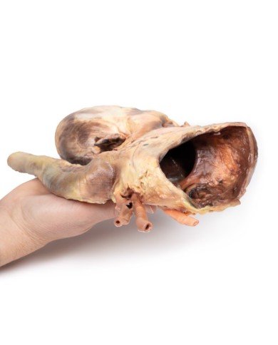 Aneurisma sifilitico Erler Zimmer 3D anatomy Series MP2042