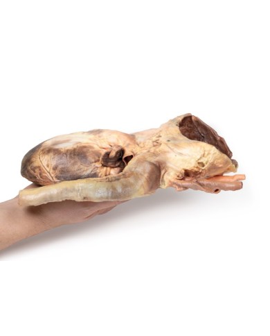 Aneurisma sifilitico Erler Zimmer 3D anatomy Series MP2042