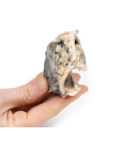 Carcinoma della laringe Erler Zimmer 3D anatomy Series MP2052