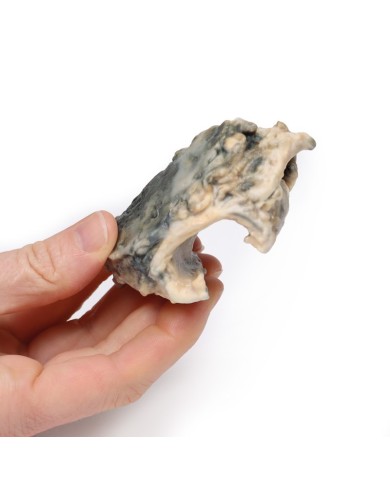 Carcinoma della laringe Erler Zimmer 3D anatomy Series MP2052