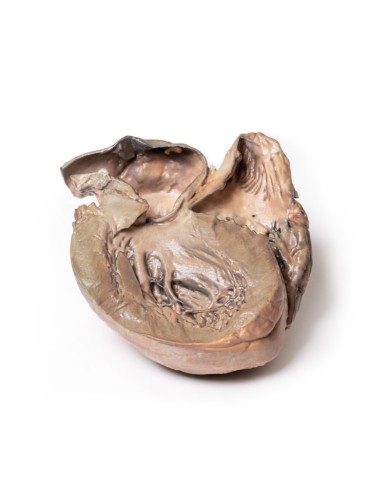 Aneurisma dell aorta toracica rotto Erler Zimmer 3D anatomy Series MP2043