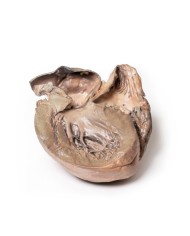 Aneurisma dell aorta toracica rotto Erler Zimmer 3D anatomy Series MP2043