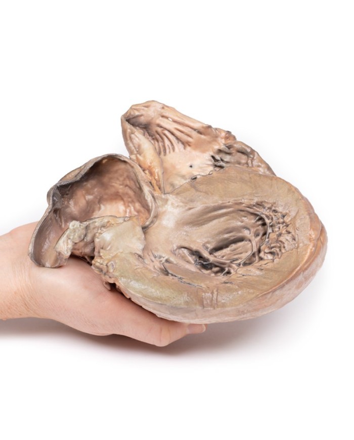 Aneurisma dell aorta toracica rotto Erler Zimmer 3D anatomy Series MP2043