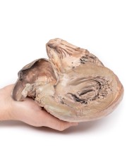 Aneurisma dell aorta toracica rotto Erler Zimmer 3D anatomy Series MP2043