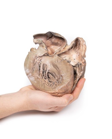 Aneurisma dell aorta toracica rotto Erler Zimmer 3D anatomy Series MP2043