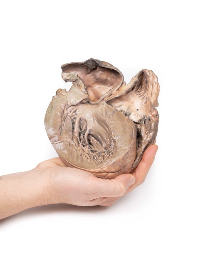 Aneurisma dell aorta toracica rotto Erler Zimmer 3D anatomy Series MP2043