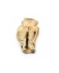 Carcinoma della laringe Erler Zimmer 3D anatomy Series MP2050 Carcinoma della laringe Erler Zimmer 3D anatomy Series MP2050