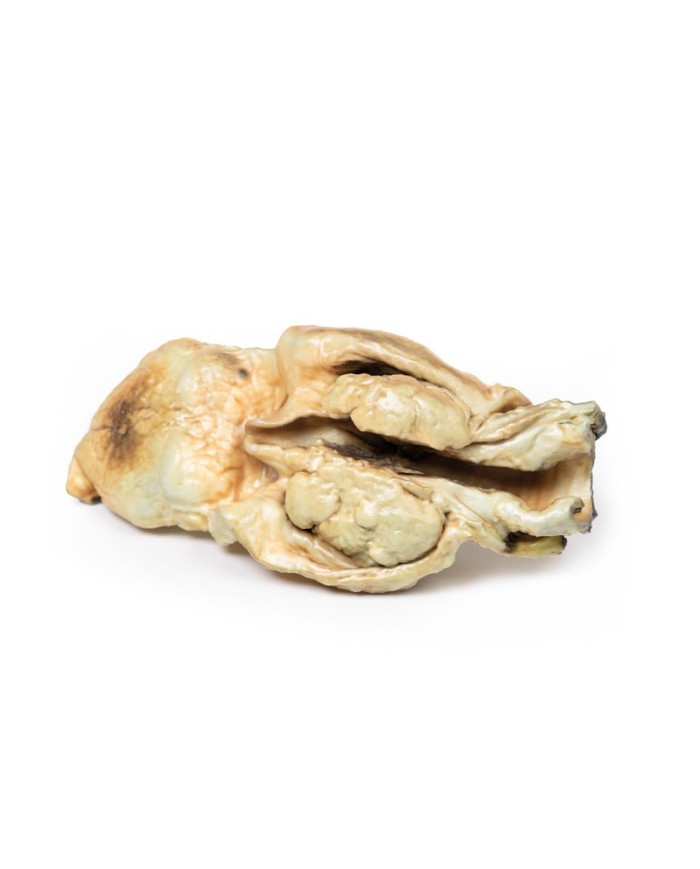 Carcinoma della laringe Erler Zimmer 3D anatomy Series MP2050 Carcinoma della laringe Erler Zimmer 3D anatomy Series MP2050