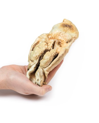 Carcinoma della laringe Erler Zimmer 3D anatomy Series MP2050