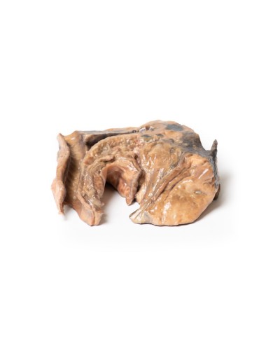 Corpo estraneo inalato trachea Erler Zimmer 3D anatomy Series MP2053