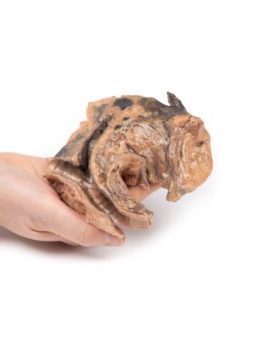 Corpo estraneo inalato trachea Erler Zimmer 3D anatomy Series MP2053