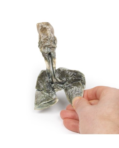 Fistola tracheoesofagea e atresia esofagea Erler Zimmer 3D anatomy Series