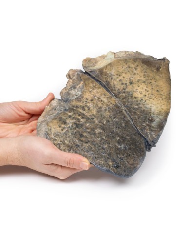 Broncopolmonite Erler Zimmer 3D anatomy Series MP2058