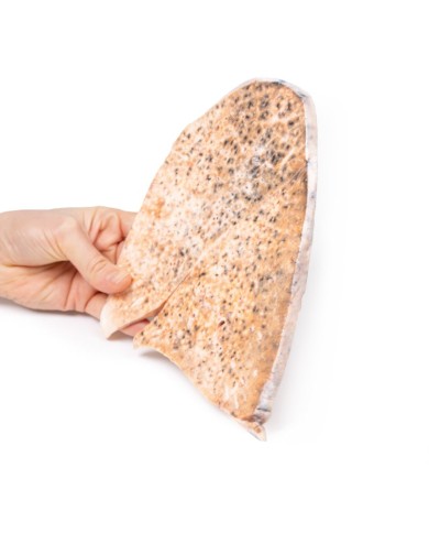 Tubercolosi miliare del polmone destro Erler Zimmer 3D anatomy Series MP2