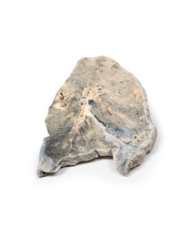 Polmone ascesso da stafilococco aureo Erler Zimmer 3D anatomy Series MP