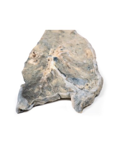 Polmone ascesso da stafilococco aureo Erler Zimmer 3D anatomy Series MP