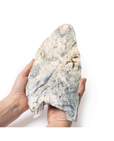 Polmone ascesso da stafilococco aureo Erler Zimmer 3D anatomy Series MP