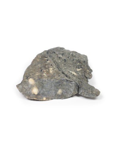 Polmone depositi multipli di carcinoma secondario nel polmone e nella pleu