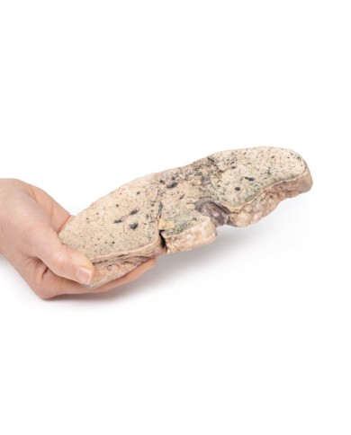 Cirrosi epatica Erler Zimmer 3D anatomy Series MP2073