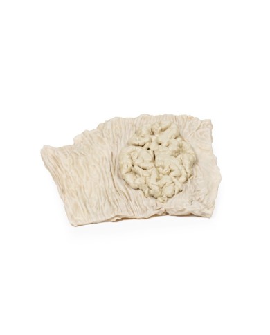 Adenoma villoso del colon Erler Zimmer 3D anatomy Series MP2071