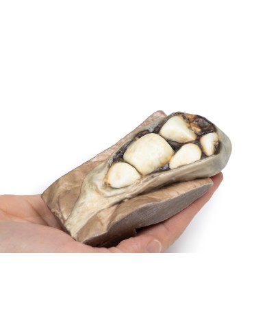 Colelitiasi calcoli biliari Erler Zimmer 3D anatomy Series MP2075