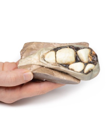 Colelitiasi calcoli biliari Erler Zimmer 3D anatomy Series MP2075