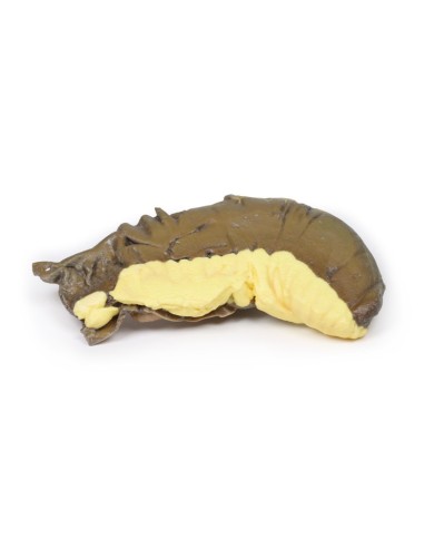 Intussuscezione dell intestino tenue da tumore metastatico Erler Zimmer 3