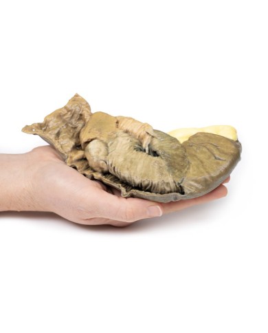 Intussuscezione dell intestino tenue da tumore metastatico Erler Zimmer 3