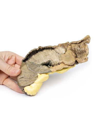 Intussuscezione dell intestino tenue da tumore metastatico Erler Zimmer 3