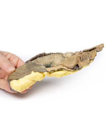 Intussuscezione dell intestino tenue da tumore metastatico Erler Zimmer 3