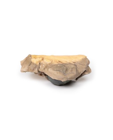 Ileo con calcoli Erler Zimmer 3D anatomy Series MP2078