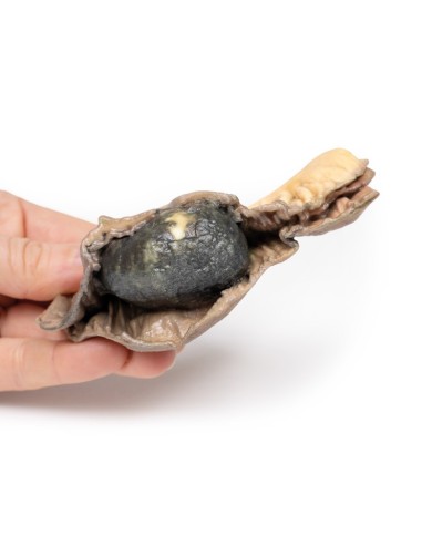 Ileo con calcoli Erler Zimmer 3D anatomy Series MP2078