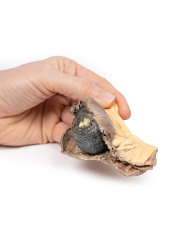 Ileo con calcoli Erler Zimmer 3D anatomy Series MP2078