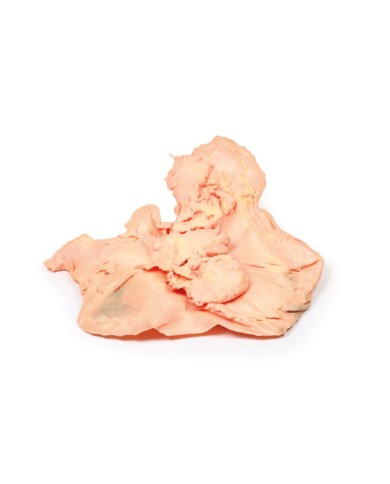 Adenocarcinoma dello stomaco Erler Zimmer 3D anatomy Series MP2080